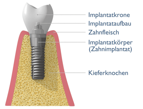 Kronen auf Implantaten